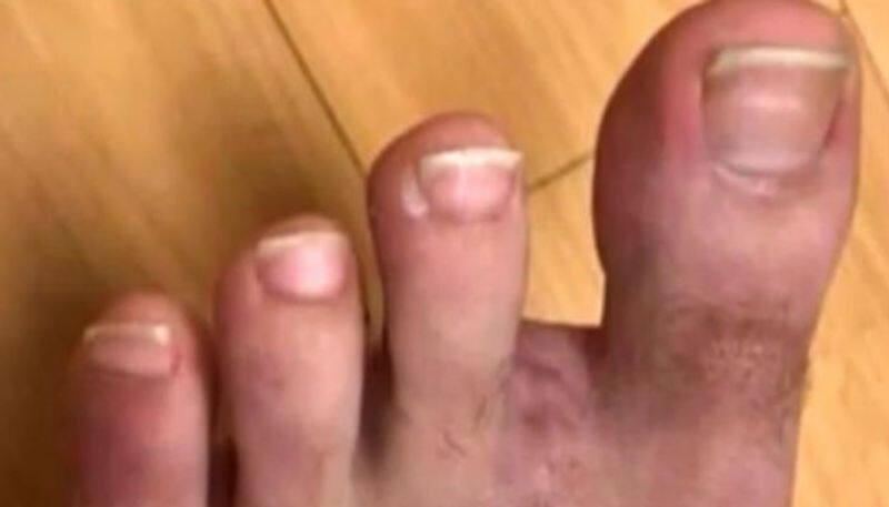doctors at michigan use mans toe to replace his thumb