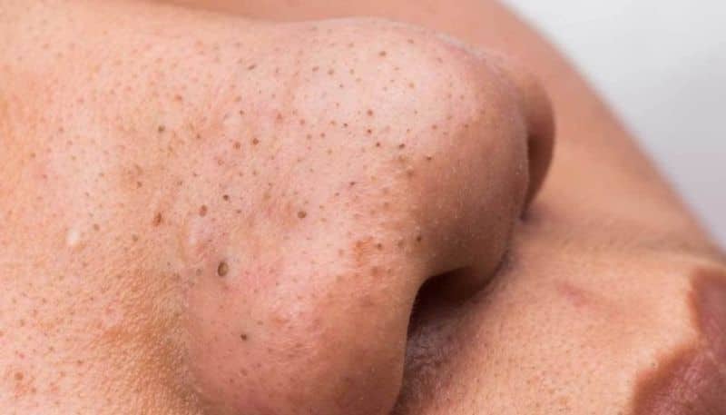 some ways to Get Rid of Blackheads