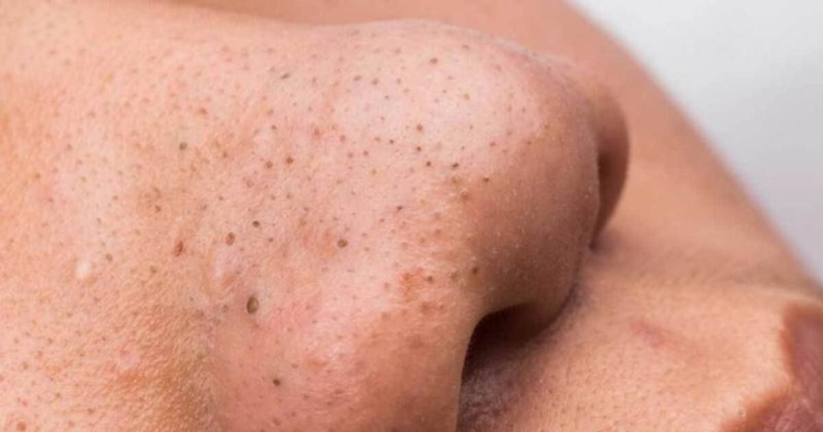  முகத்தில் இருக்கும் கரும்புள்ளிகளை நீங்க வேண்டுமா? வீட்டு கிட்சனில் இருக்கும் பொருட்களை இப்படி யூஸ் பண்ணுங்க!