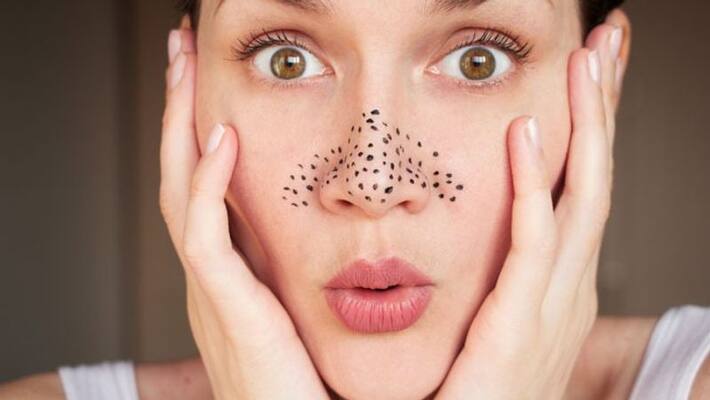 To get rid of blackheads problem try Five effective home remedies To get rid of blackheads problem try Five effective home remedies