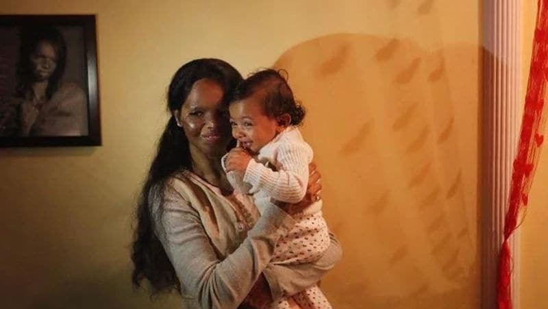 Rarely seen photos of chhapaak lead acid attack survivor laxmi Agarwal kph
