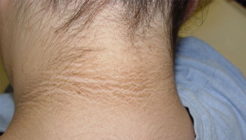 Tired by using skin lightening cream use this home remedies to lighten the neck
