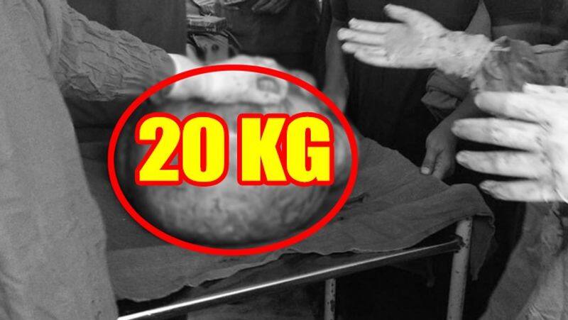 20 kg cancer cyst removed a lady patient in chennai Government Hospital For Women & Children