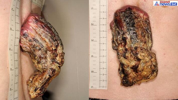 50 year British patient with a 5 inch dragon horn on his back kpt 50 year British patient with a 5 inch dragon horn on his back kpt