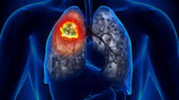 world lung day 2023 know about four important lung diseases-rse- world lung day 2023 know about four important lung diseases-rse-
