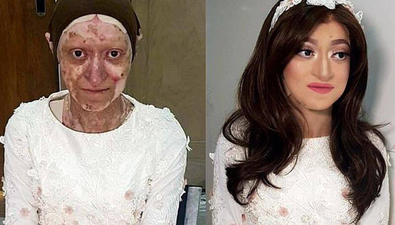 woman who wakes up STUCK to her bed every morning and  reveals rare skin condition