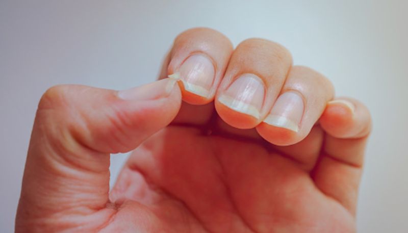 What nail colors says about your health condition