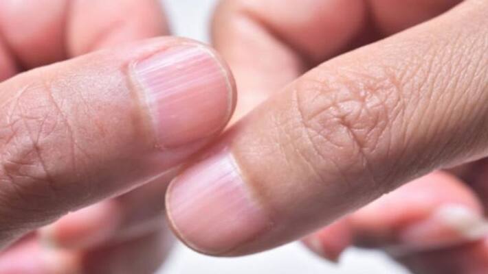 various causes behind ridges on nails various causes behind ridges on nails