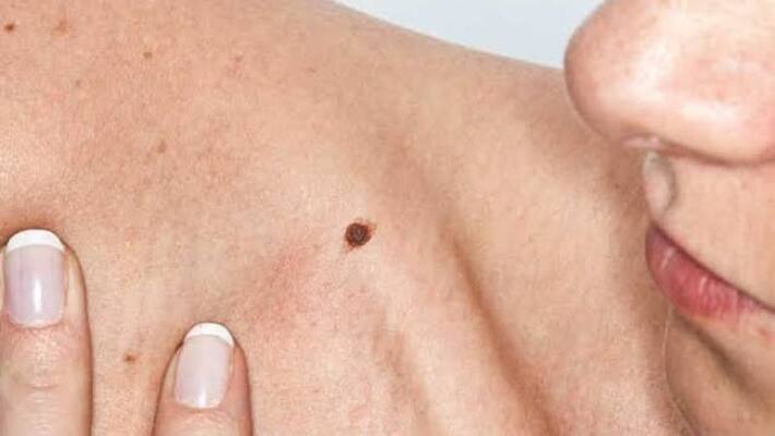 signs and symptoms of skin cancer signs and symptoms of skin cancer
