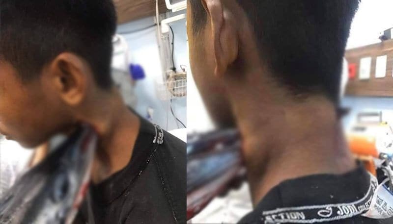 Teenage boy seriously injured after needle fish piercing through back of neck