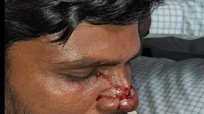 Municipal elections: Congress candidates bites TRS candidate nose Municipal elections: Congress candidates bites TRS candidate nose