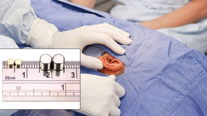 School students undergo surgeries to remove listening devices used for cheating in exams School students undergo surgeries to remove listening devices used for cheating in exams