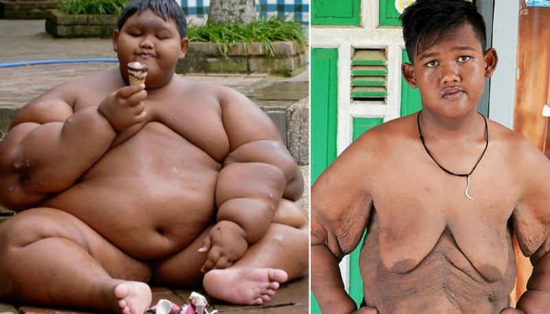 how 190 worlds fattest boy arya permana loss 170 to 83 kg weight loss story