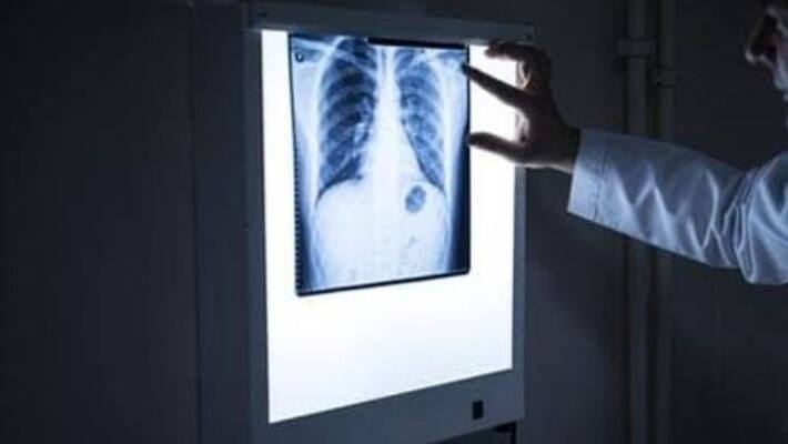 doctors found pen cap from 12 year boys lung after he brought to hospital with persistent cough and cold in Kolkata doctors found pen cap from 12 year boys lung after he brought to hospital with persistent cough and cold in Kolkata