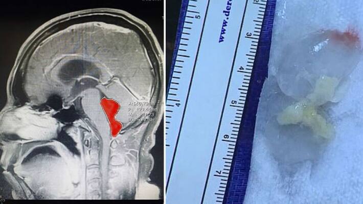 doctors removed tape worm from mans brain doctors removed tape worm from mans brain