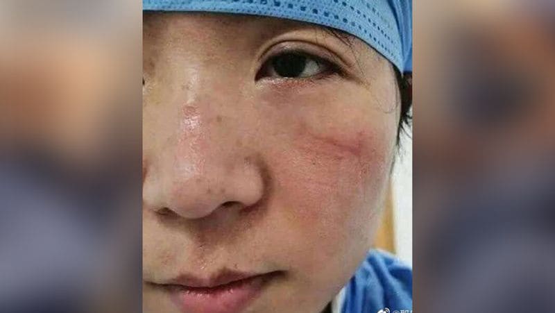 मरीजों का इलाज करने के दौरान डॉक्टर्स को बेहद कसा हुआ मास्क पहनना पड़ता है, ताकि वायरस उन्हें अपनी चपेट में ना ले ले।