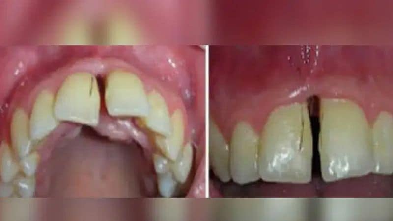 डॉक्टर्स ने उसके मुंह के अंदर से छोटे-छोटे बाल खींच कर निकाले। इसकी तस्वीरें सोशल मीडिया पर वायरल हो रही है।