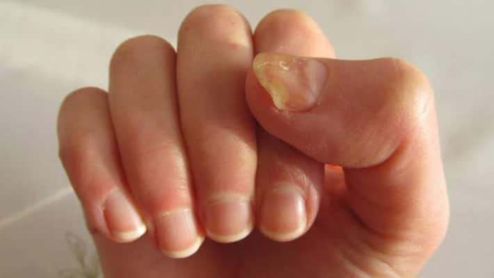 how do you get rid of toenail infection fast BRd how do you get rid of toenail infection fast BRd