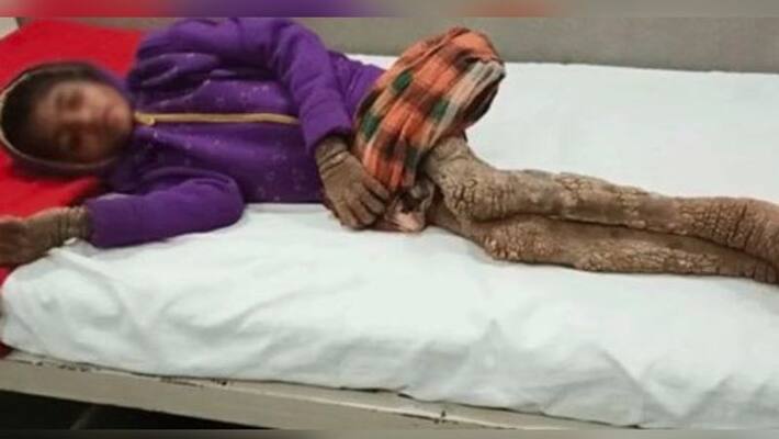 8 year old girl battles rare condition turning with tree man syndrome 8 year old girl battles rare condition turning with tree man syndrome