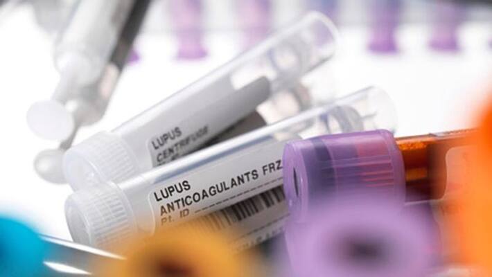 SLE is a rare kind of autoimmune disease SLE is a rare kind of autoimmune disease