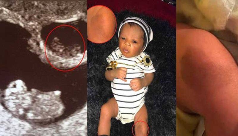 Baby dies and  vanishes in the womb