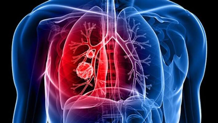 three common symptoms Lung cancer three common symptoms Lung cancer