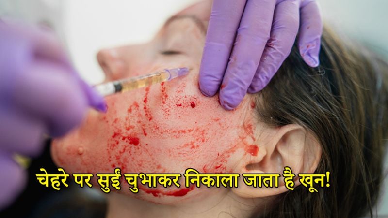 what is vampire facial cost and full procedure blood facial technique kpt