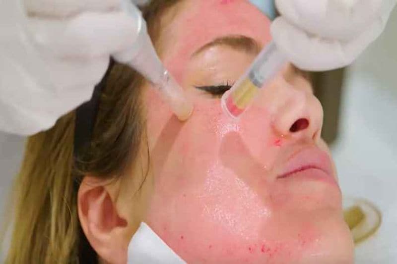 what is vampire facial cost and full procedure blood facial technique kpt