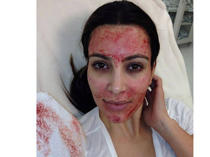 what is vampire facial cost and full procedure blood facial technique kpt