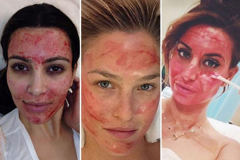 what is vampire facial cost and full procedure blood facial technique kpt