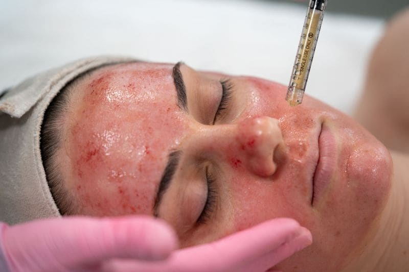 what is vampire facial cost and full procedure blood facial technique kpt