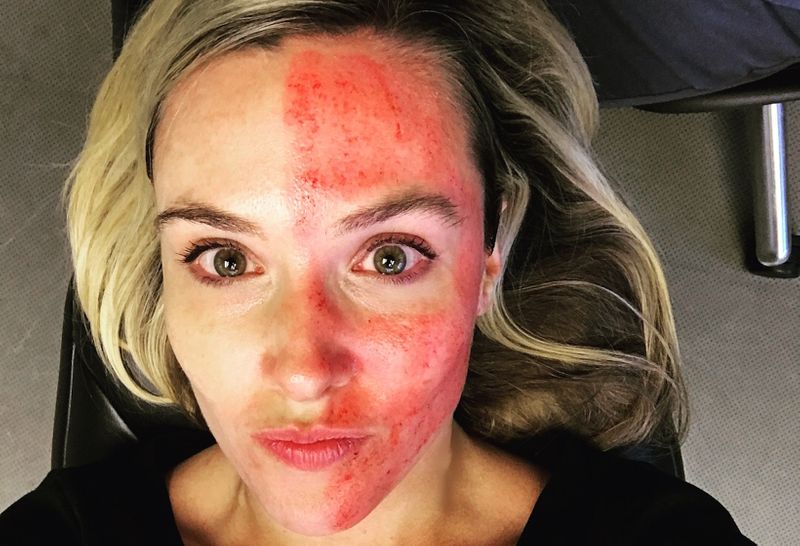 what is vampire facial cost and full procedure blood facial technique kpt