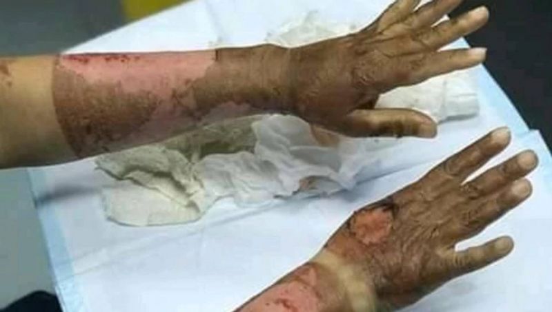 sanitizer burn womans hands because its contained alcohol fake claim viral kpt