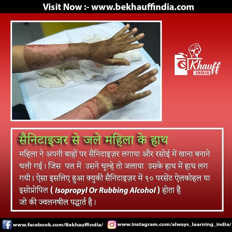 sanitizer burn womans hands because its contained alcohol fake claim viral kpt