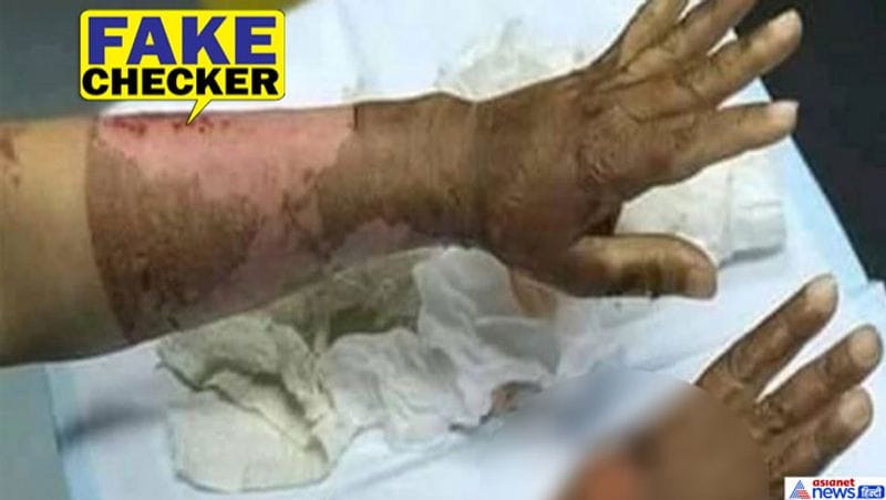 sanitizer burn womans hands because its contained alcohol fake claim viral kpt