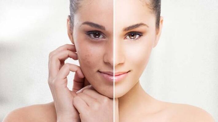 Increased pigmentation in intense sunlight is getting brighter skin BDD Increased pigmentation in intense sunlight is getting brighter skin BDD