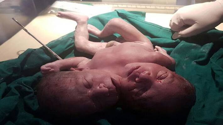 civil hospital woman baby born two heads child in chhattisgarh kpr civil hospital woman baby born two heads child in chhattisgarh kpr