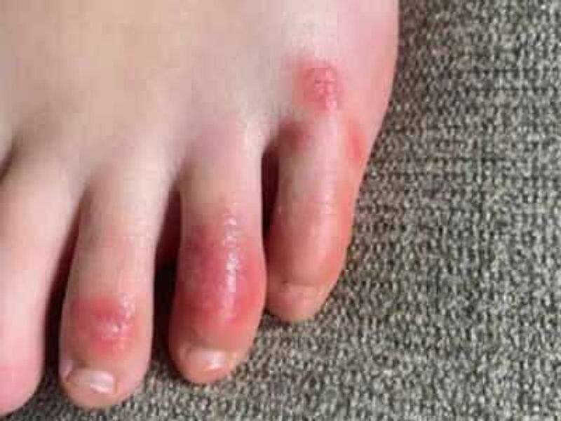 स वध न नए र प म द ख क र न अब सर द ख स नह स ज रह प र क अ ग ल य फ र पड रह छ ल New Symptoms Of Novel Coronavirus Covid Toes Among Kids Kps