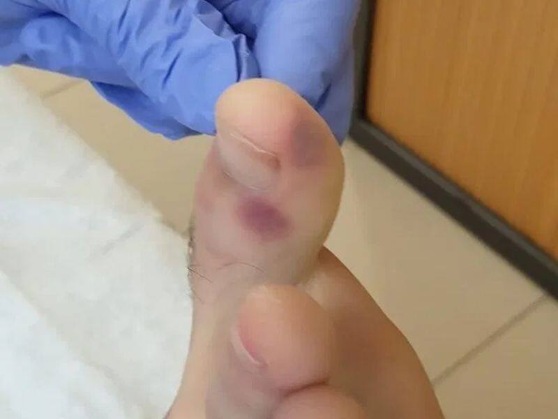 स वध न नए र प म द ख क र न अब सर द ख स नह स ज रह प र क अ ग ल य फ र पड रह छ ल New Symptoms Of Novel Coronavirus Covid Toes Among Kids Kps