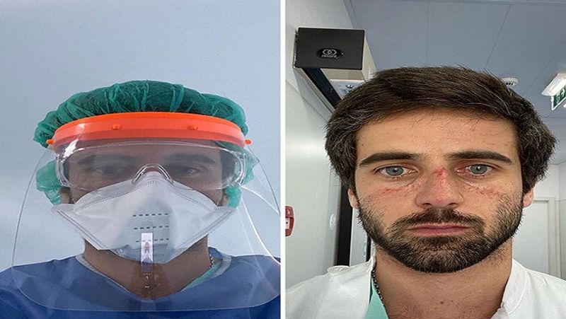 कोविड के मरीजों के इलाज में लगे इस डॉक्टर के चेहरे पर भी लगातार मास्क पहने रहने से स्कार्स पड़ गए हैं और उनसे खून निकलता है। इसके बावजूद ये मरीजों के इलाज में लगे रहते हैं। ऐसे बहुत डॉक्टर हैं, जिन्हें घर जाने का मौका नहीं मिल पाता। 