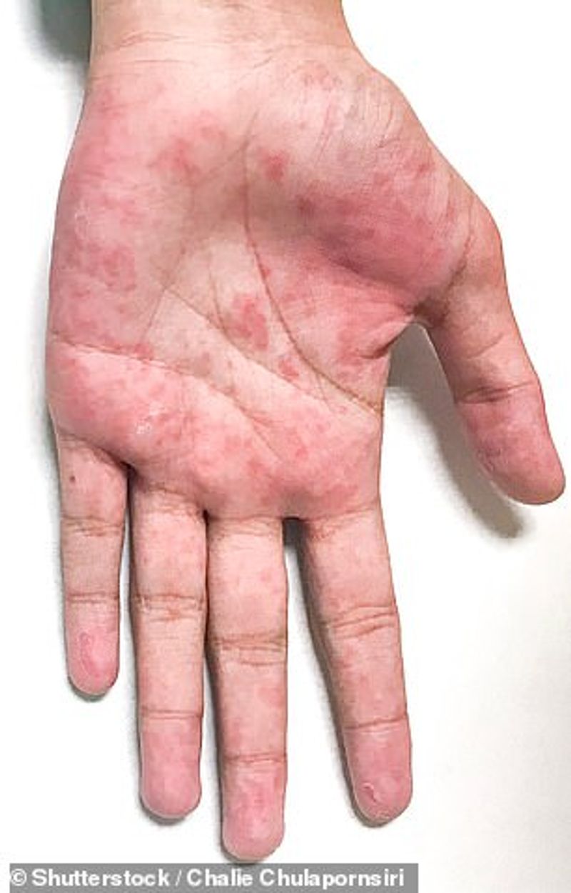 symptoms of blood clot not to ignore it can be the cause of death BRD