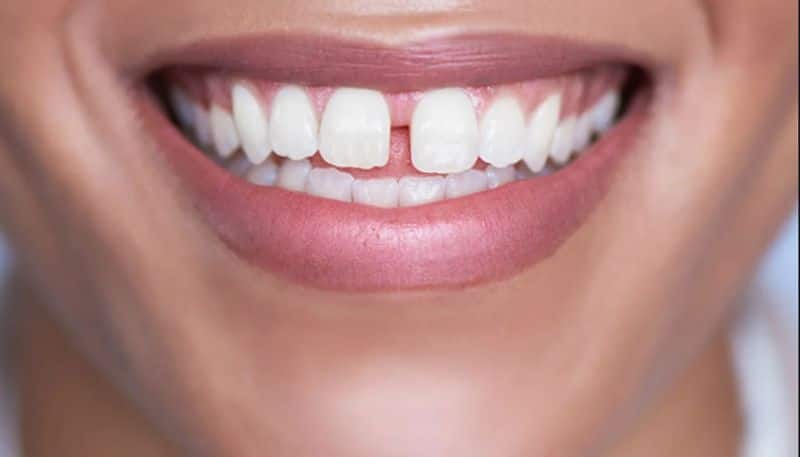 Gap between teeth means it is a sign of Good luck..