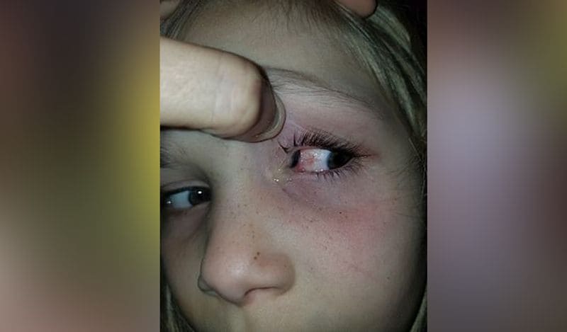 horrific photos of beetle coming out of 6 year old girl will churn your stomach kph