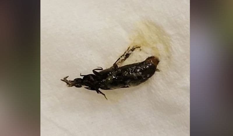 horrific photos of beetle coming out of 6 year old girl will churn your stomach kph