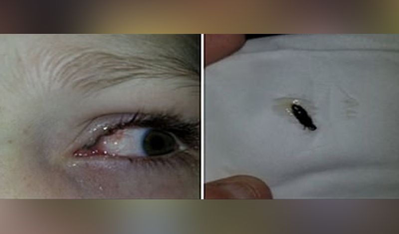 horrific photos of beetle coming out of 6 year old girl will churn your stomach kph