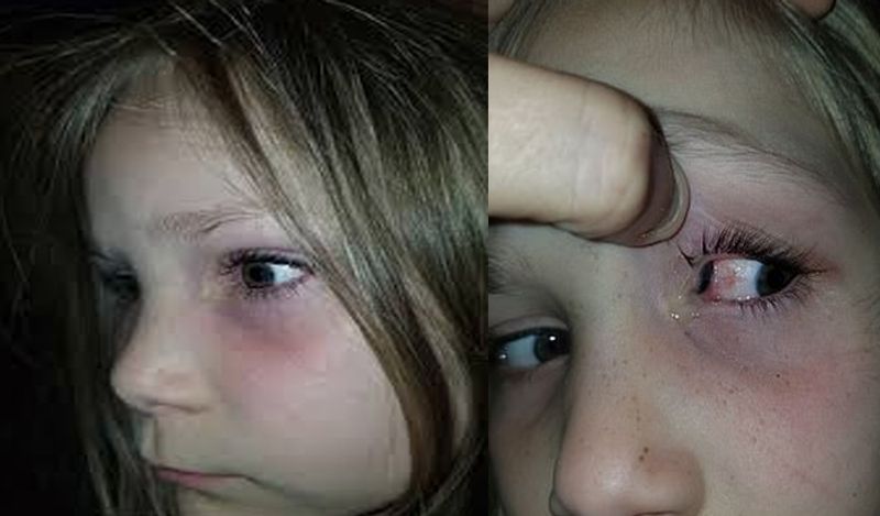 horrific photos of beetle coming out of 6 year old girl will churn your stomach kph