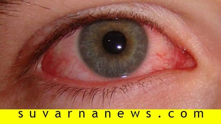 Amid Of Coronavirus Madras Eye Cases Are Increasing In Bengaluru Amid Of Coronavirus Madras Eye Cases Are Increasing In Bengaluru