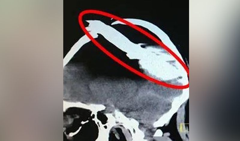 जानकारी मुताबिक, ये मामला चीन से सामने आया जहां 52 साल के एक ठेकेदार के साथ ये हादसा हुआ। शख्स काम कर रहा था, तभी उसका पैर फिसल गया और वो वहां पड़े स्टील के रॉड पर गिर गया। 