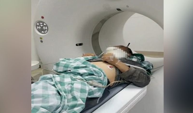 शख्स को जल्दबाजी में अस्पताल लाया गया। वहां उसकी हालत देख डॉक्टर्स भी घबरा गए। शख्स का सिटी स्कैन किया गया, जिसमें पता चला कि उसके सिर के अंदर 6 इंच स्टील घुसा हुआ है।
