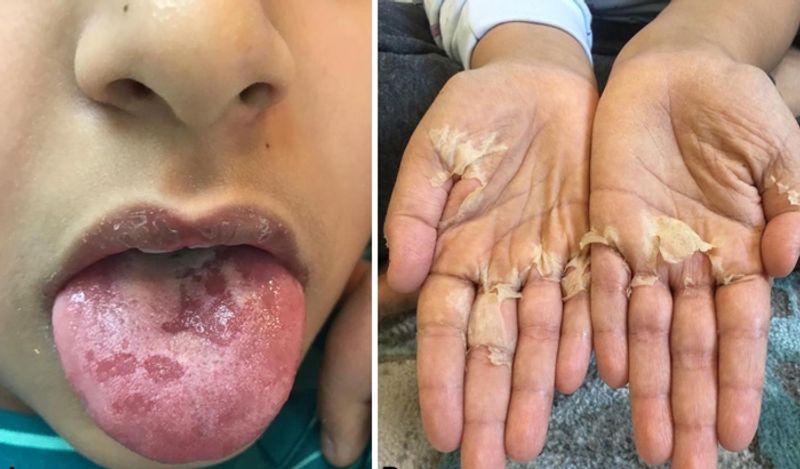 वॉशिंगटन पोस्ट की रिपोर्ट के मुताबकि, अभी सैन डिएगो और न्यूयॉर्क में इस वायरस के मामले काफी बढ़ गए हैं। डॉक्टर्स के मुताबिक, कावासाकी कोरोना के खिलाफ बॉडी का एक इम्यून रेस्पोंस है। 